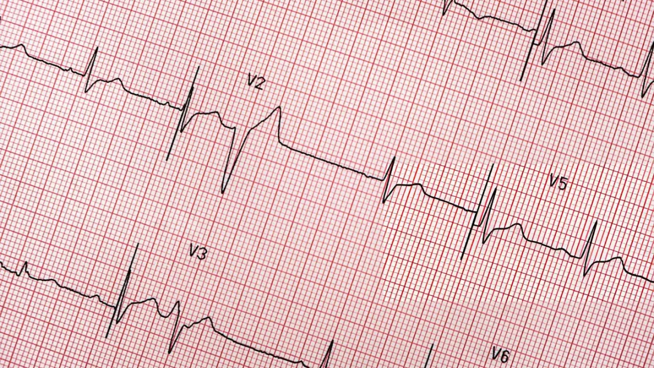 Abnormal ECG Ne Demek?